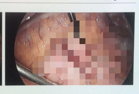 摘出された腫瘍・ぼかし入り